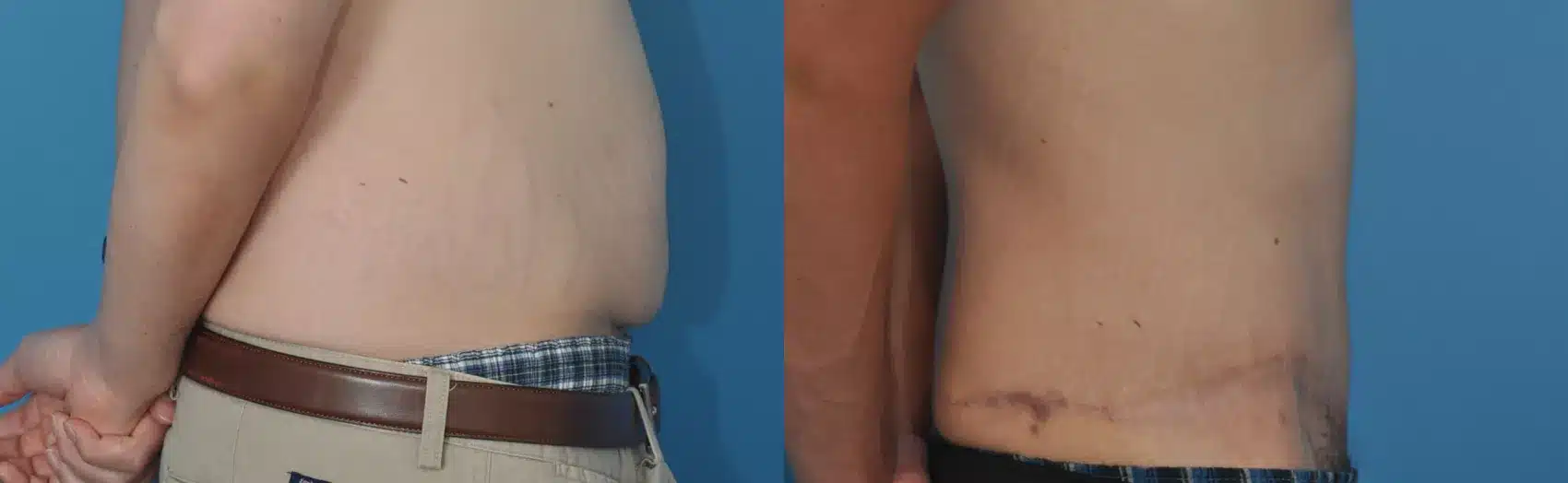 Before and After Image: Case #22 - right-side