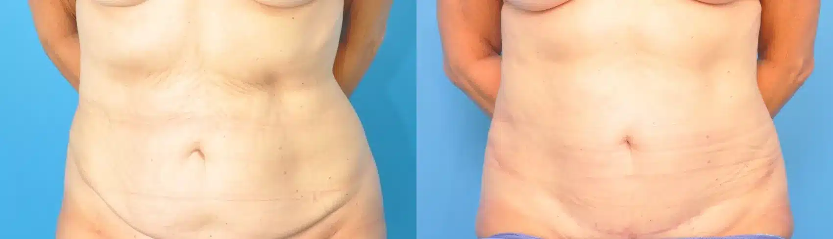 Before and After Image: Case #220 - front