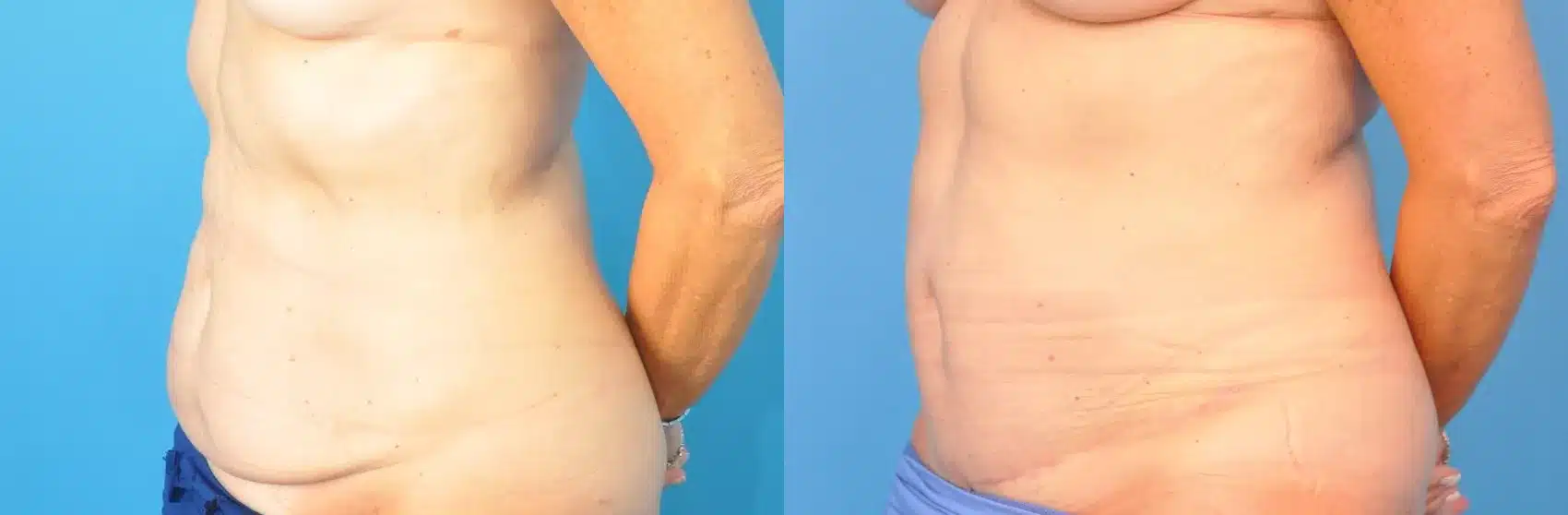 Before and After Image: Case #220 - left-front-oblique