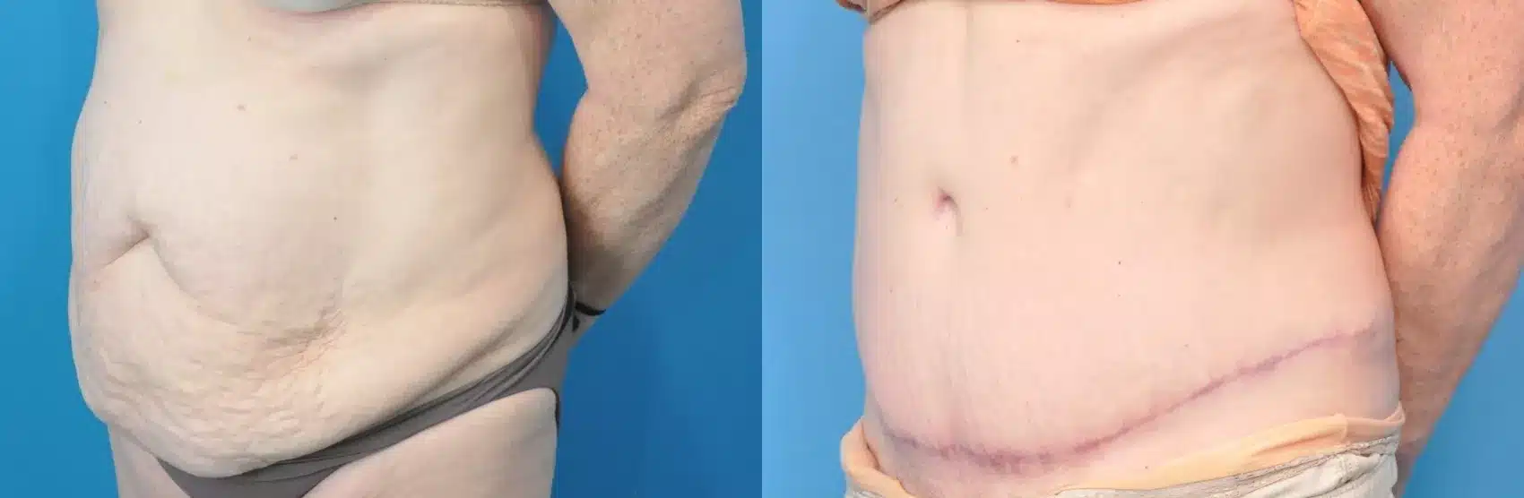 Before and After Image: Case #221 - left-front-oblique