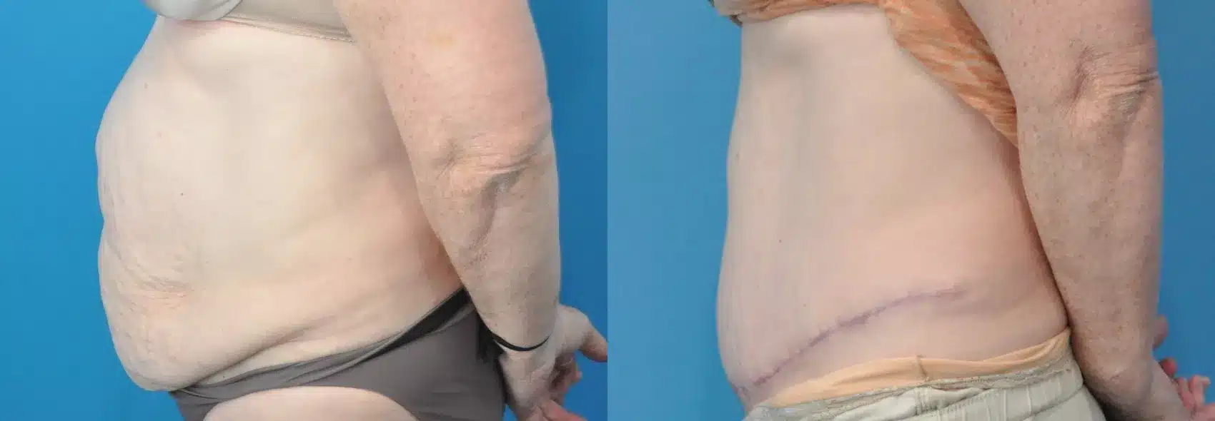 Before and After Image: Case #221 - left-side