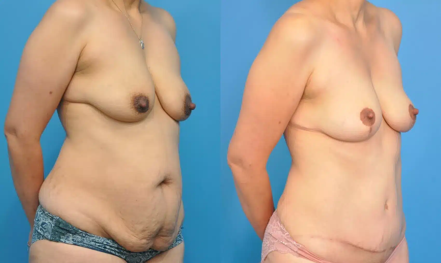 Before and After Image: Case #222 - right-front-oblique