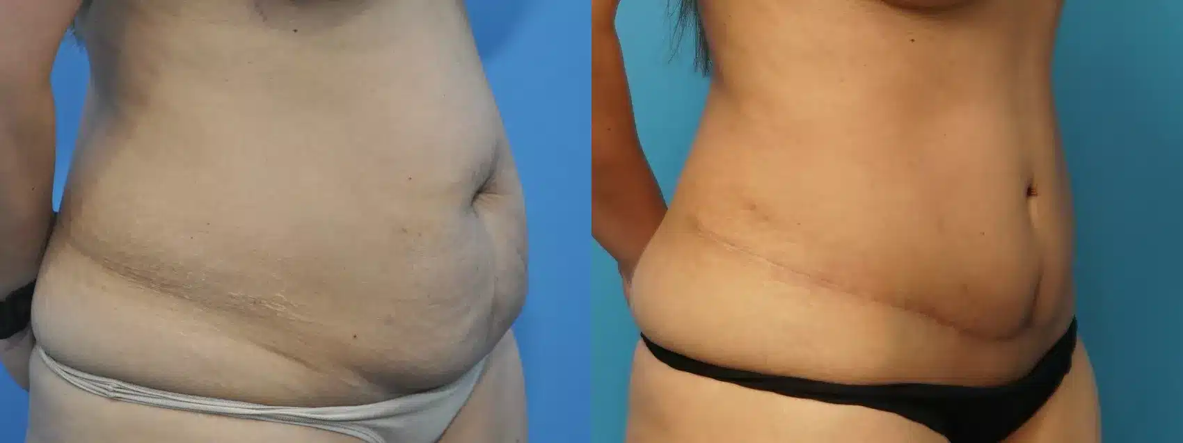 Before and After Image: Case #226 - right-front-oblique