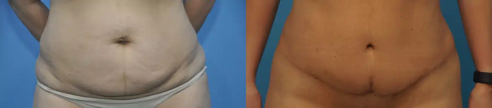 Before and After Image: Case #226 - front