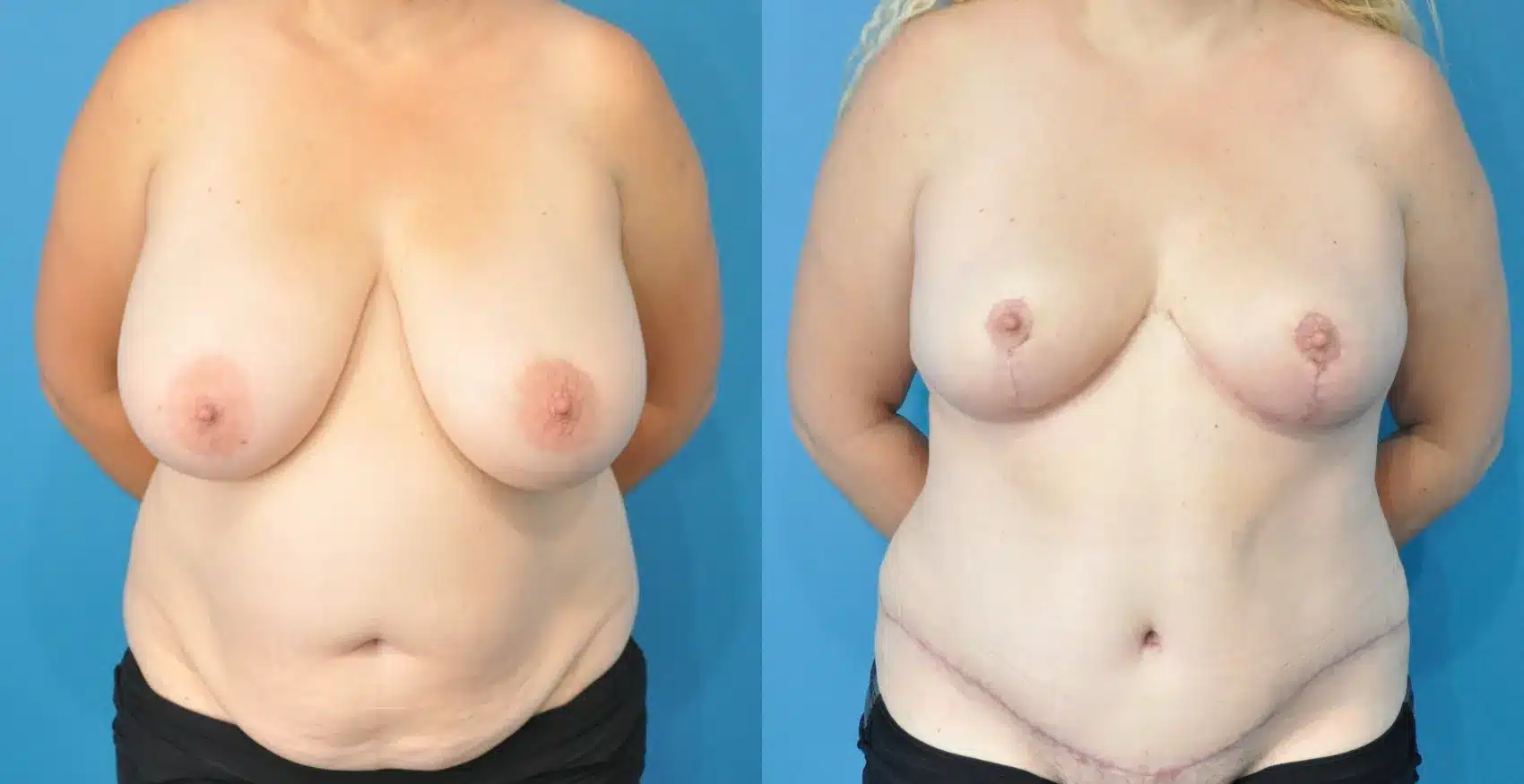 Before and After Image: Breast Reduction/Lift and Tummy Tuck - front