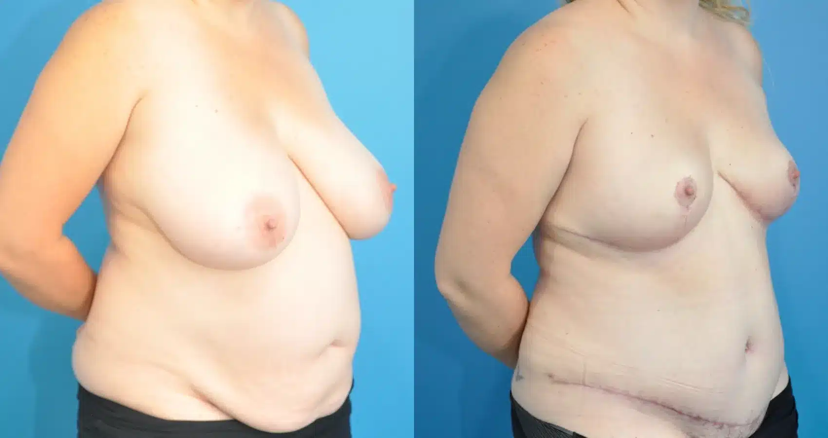 Before and After Image: Breast Reduction/Lift and Tummy Tuck - right-front-oblique