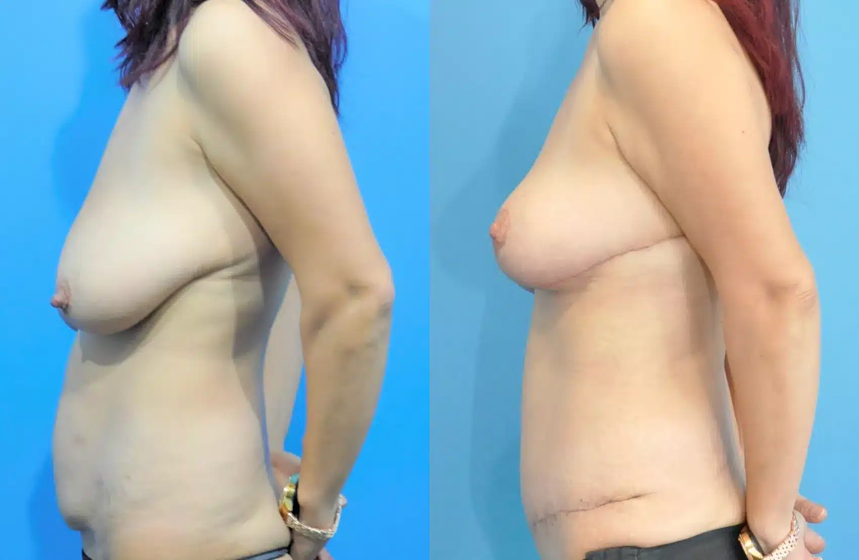 Before and After Image: Case #232 - left-side