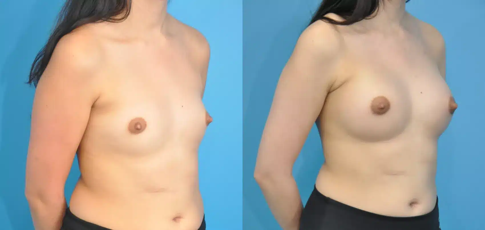 Before and After Image: Case #234 - right-front-oblique