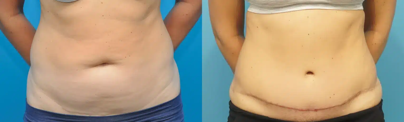 Before and After Image: Case #235 - front