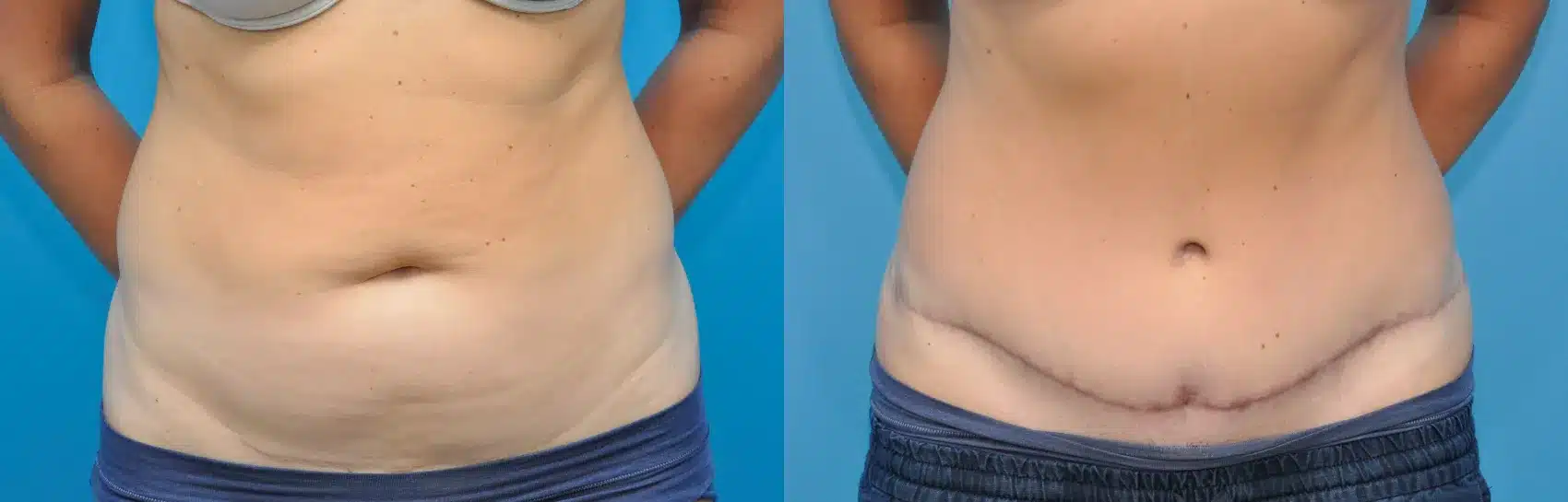 Before and After Image: Case #235 - front