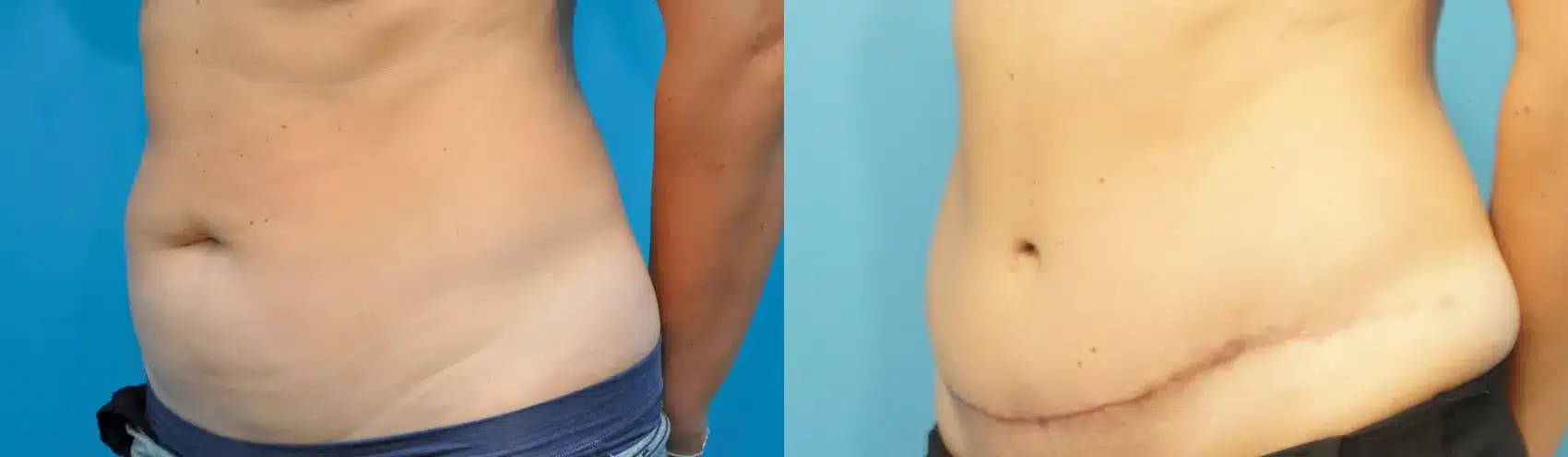 Before and After Image: Case #235 - left-front-oblique