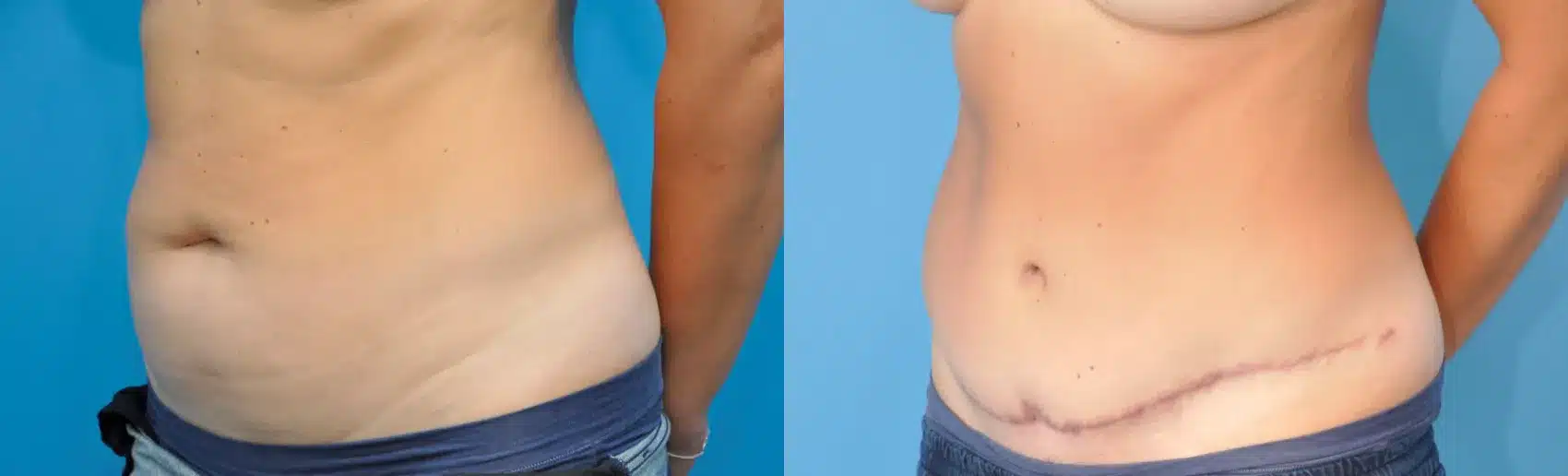 Before and After Image: Case #235 - left-front-oblique