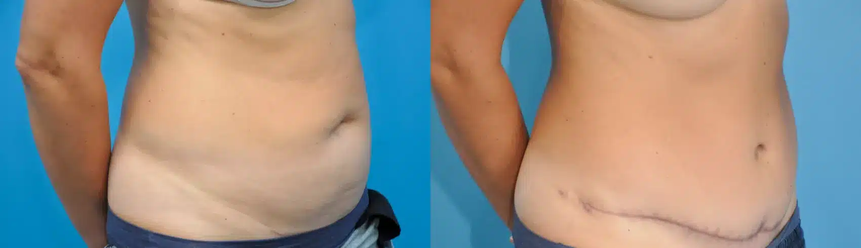 Before and After Image: Case #235 - right-front-oblique