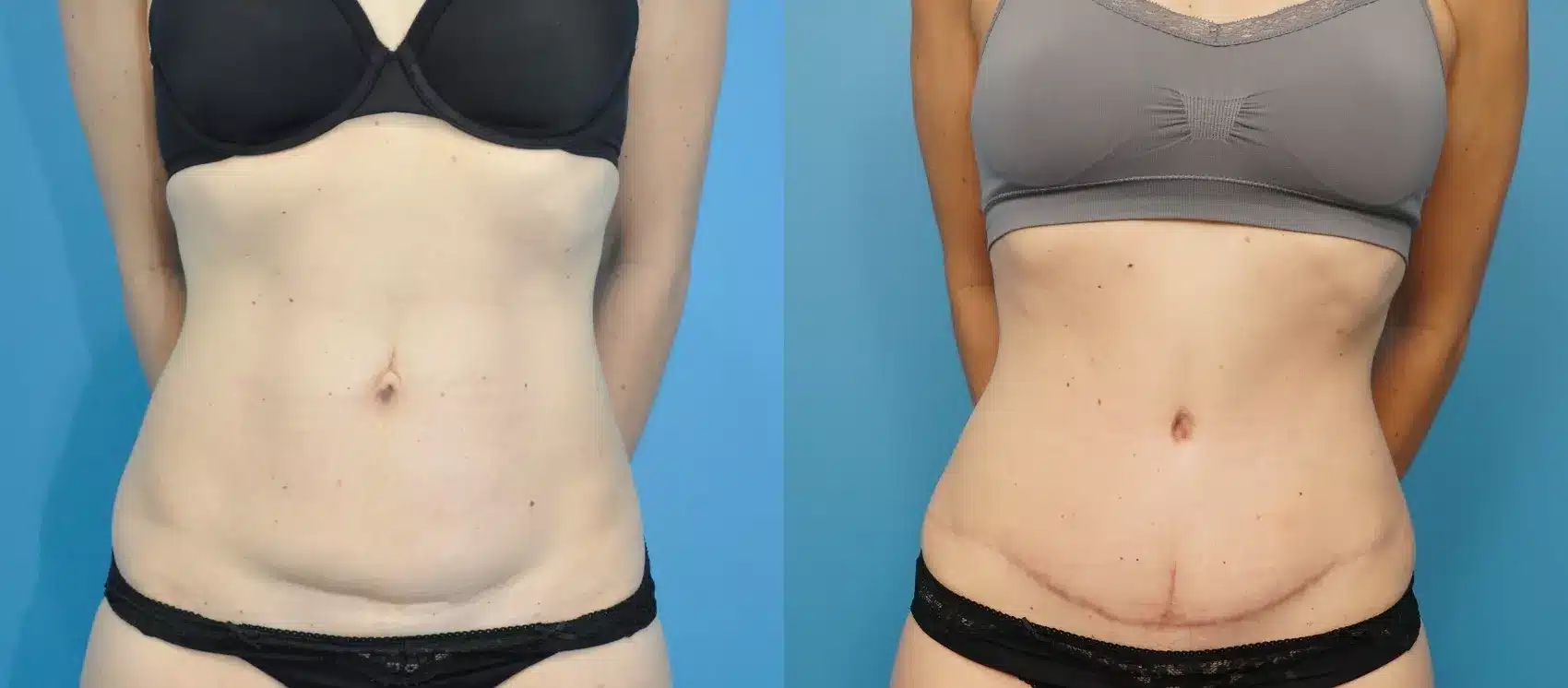 Before and After Image: Case #236 - front