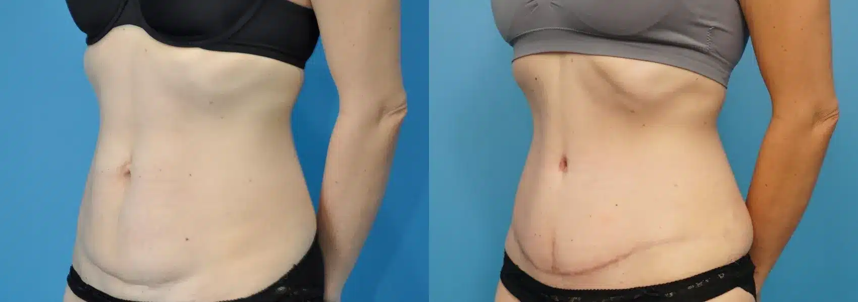 Before and After Image: Case #236 - left-front-oblique