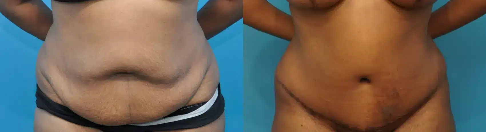 Before and After Image: Case #238 - front