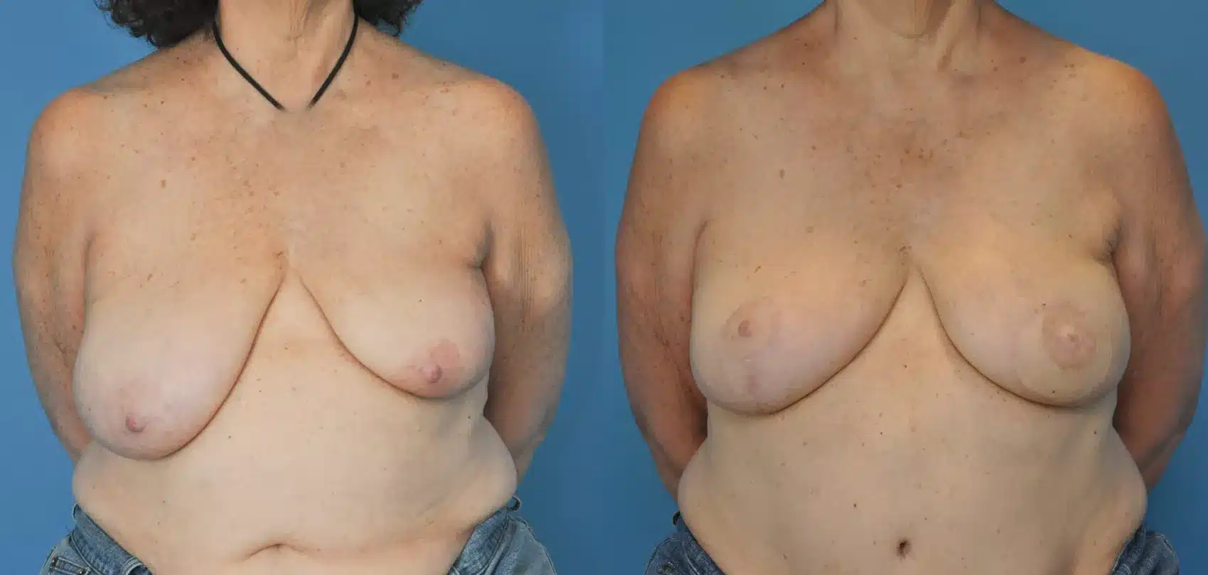Before and After Image: Case #24 - front