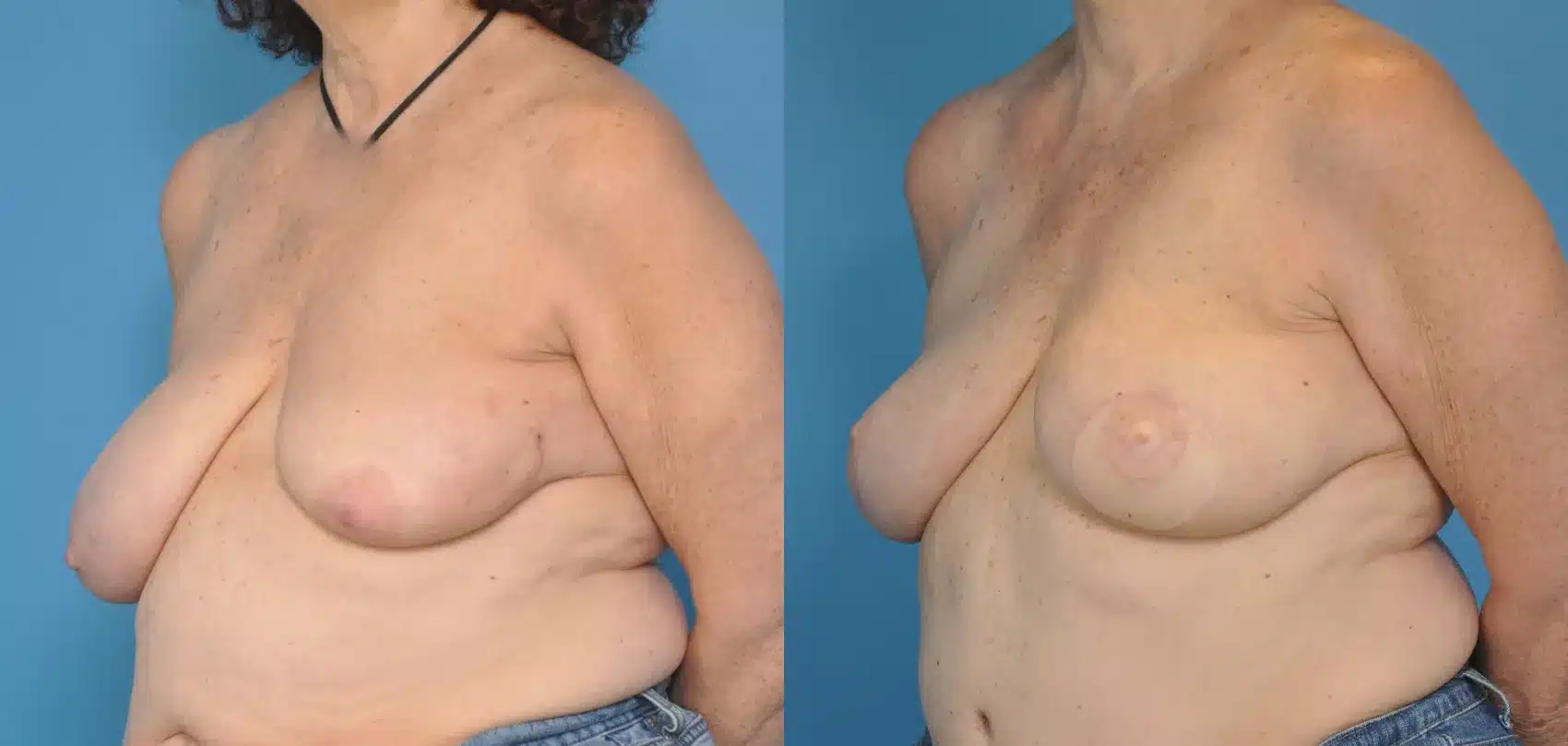 Before and After Image: Case #24 - left-front-oblique