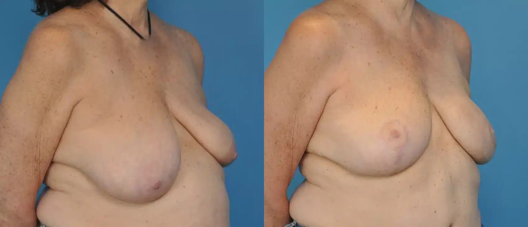 Before and After Image: Case #24 - right-front-oblique