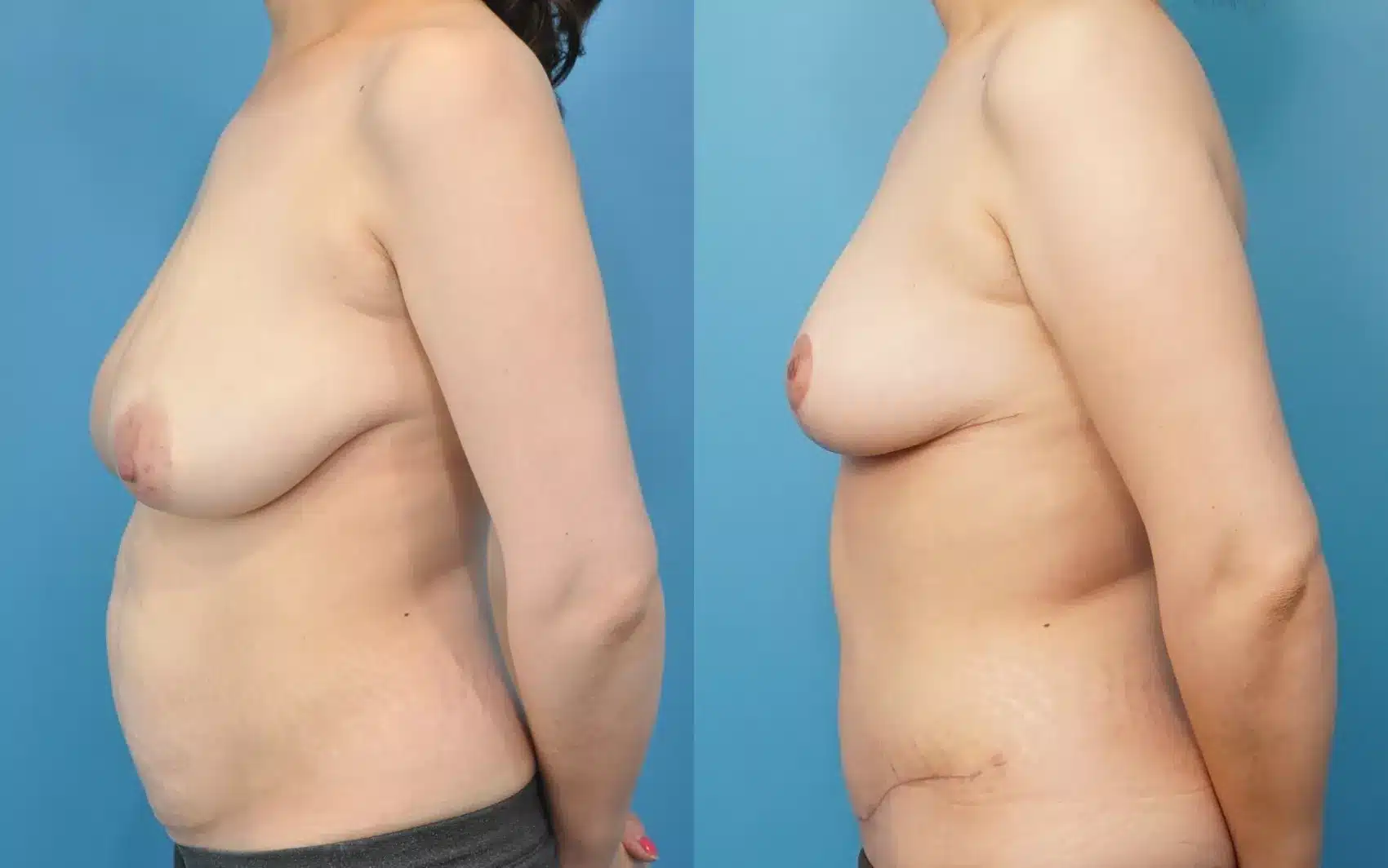 Before and After Image: Case #240 - left-side