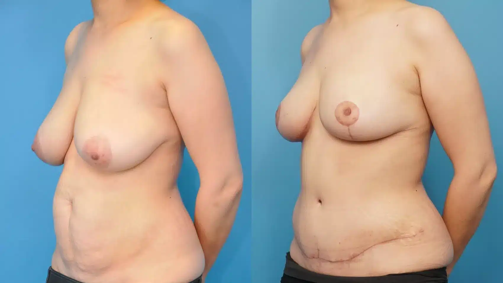 Before and After Image: Case #240 - left-front-oblique