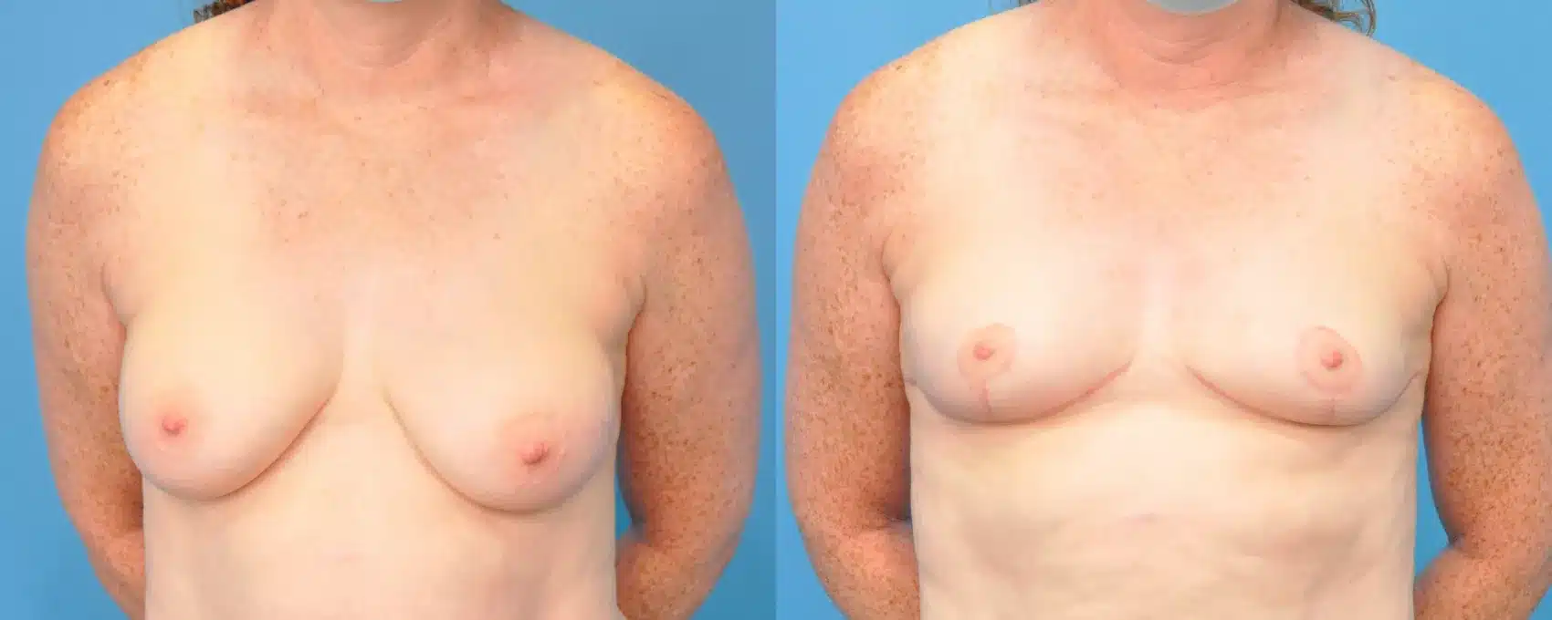 Before and After Image: Breast Reduction and Lift - front