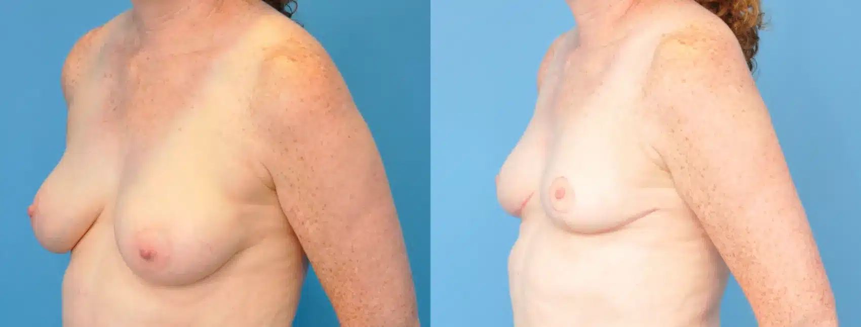 Before and After Image: Breast Reduction and Lift - left-front-oblique