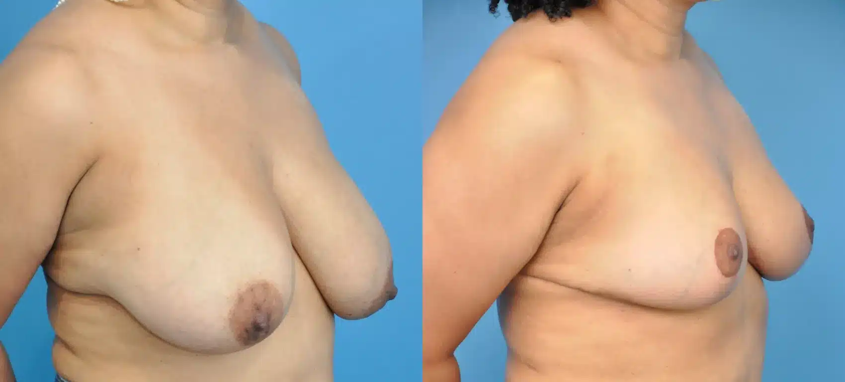 Before and After Image: Breast Reduction and Lift - right-front-oblique