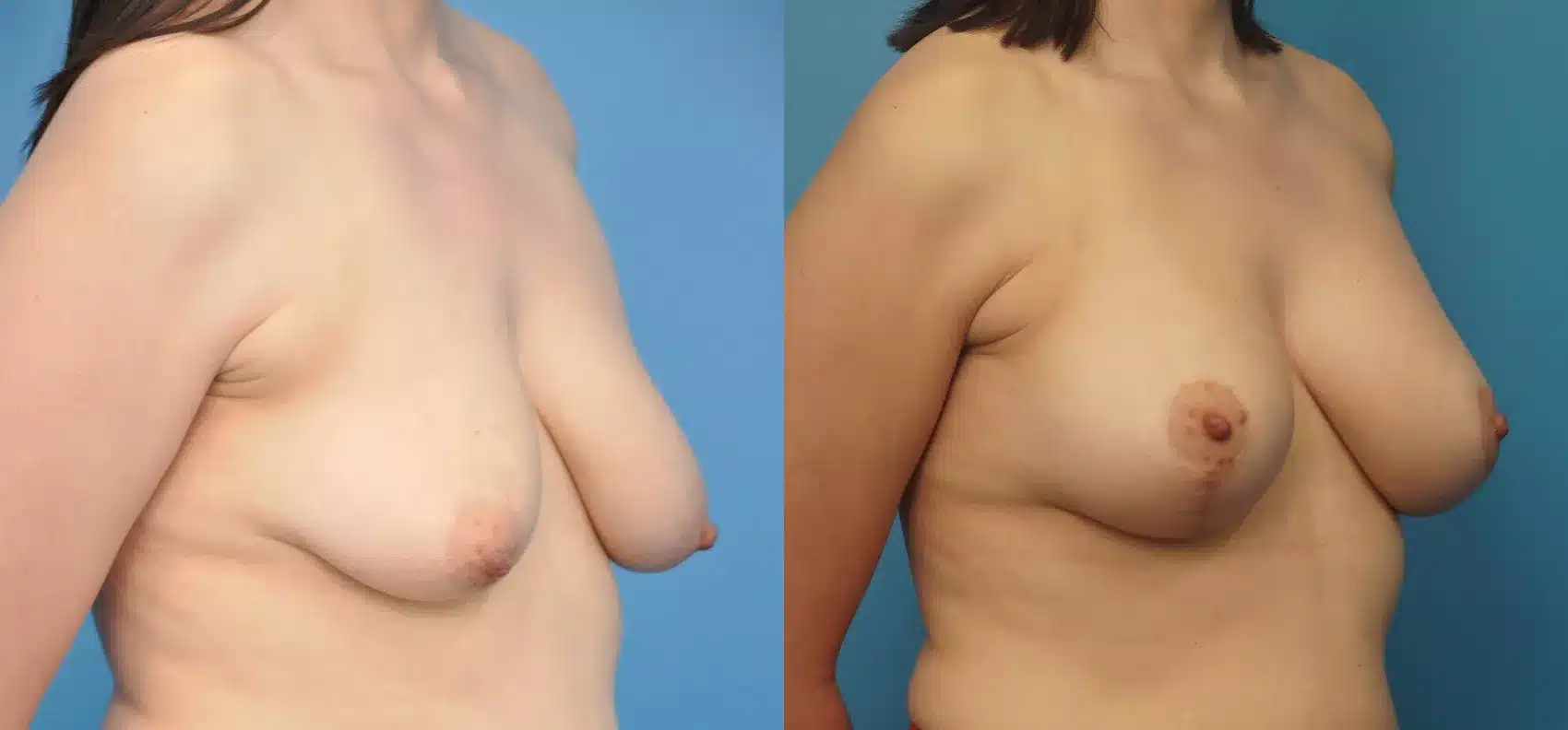 Before and After Image: Case #246 - right-front-oblique