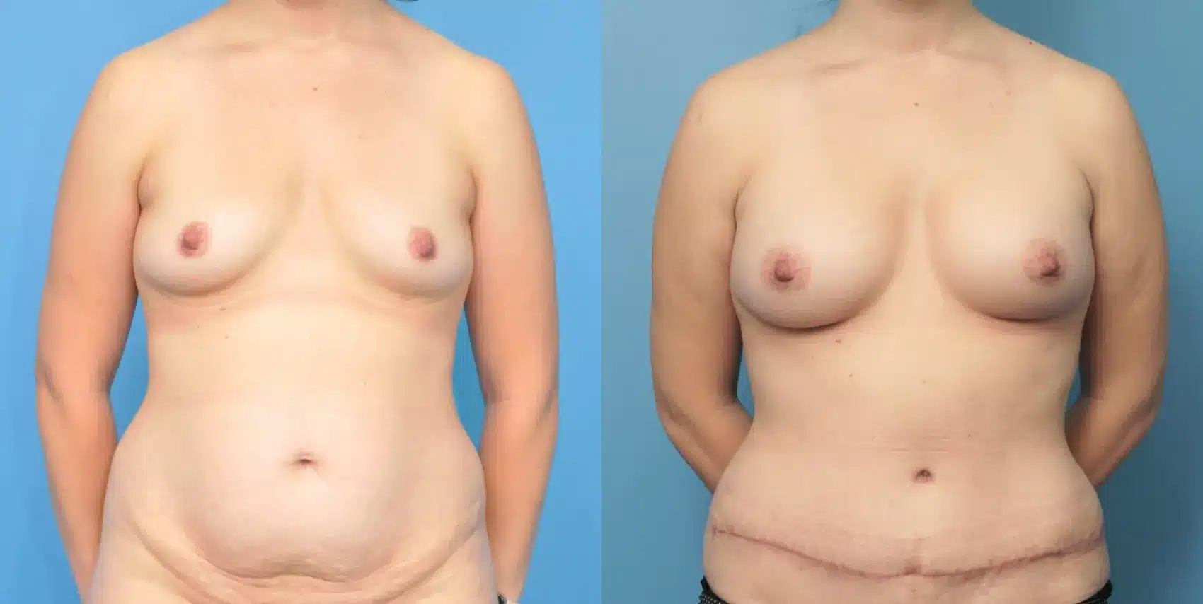Before and After Image: Breast Augmentation with Abdominoplasty - front