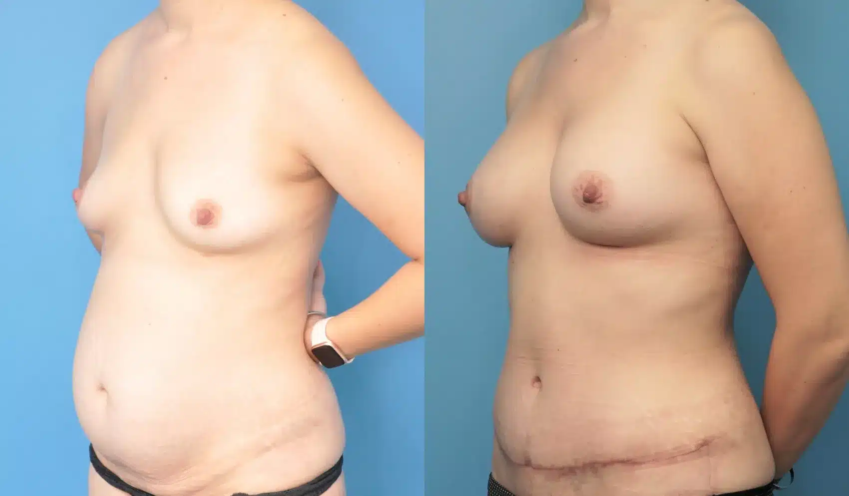 Before and After Image: Breast Augmentation with Abdominoplasty - left-front-oblique