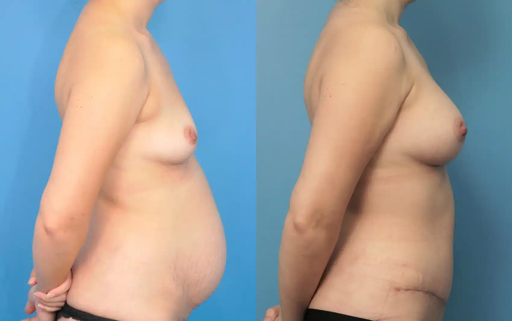 Before and After Image: Breast Augmentation with Abdominoplasty - right-side