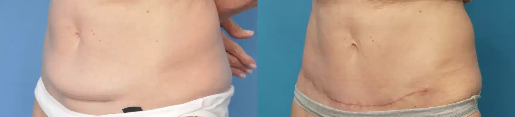 Before and After Image: Case #249 - left-front-oblique