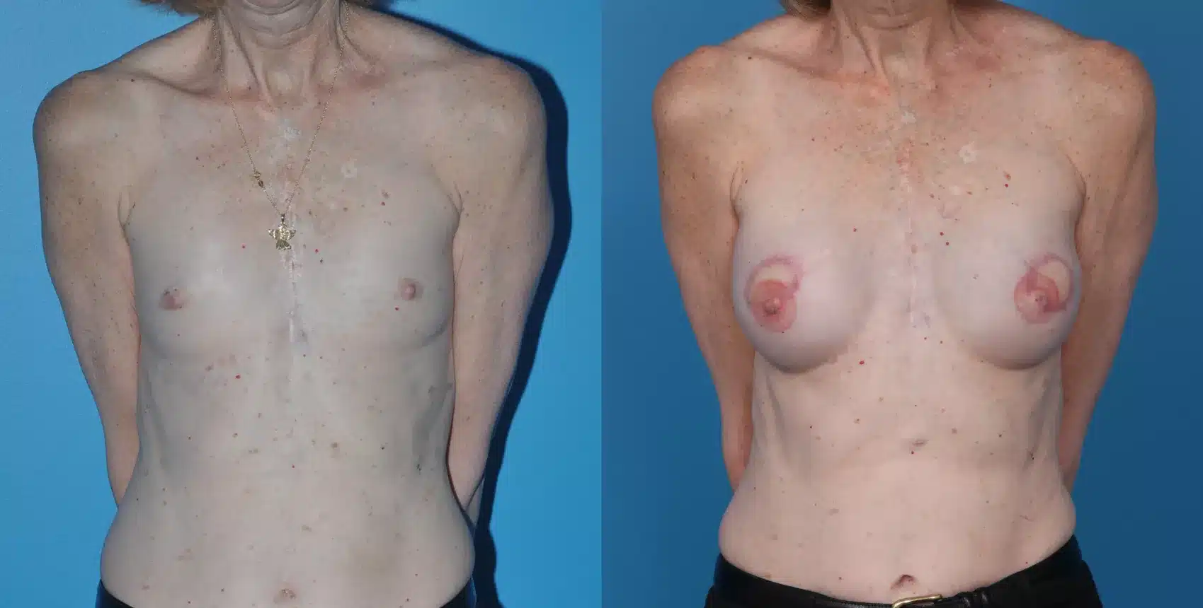 Before and After Image: Case #25 - front