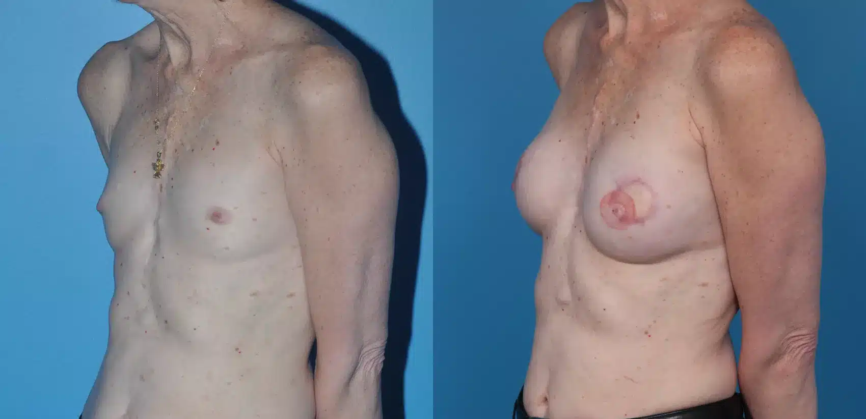 Before and After Image: Case #25 - left-front-oblique