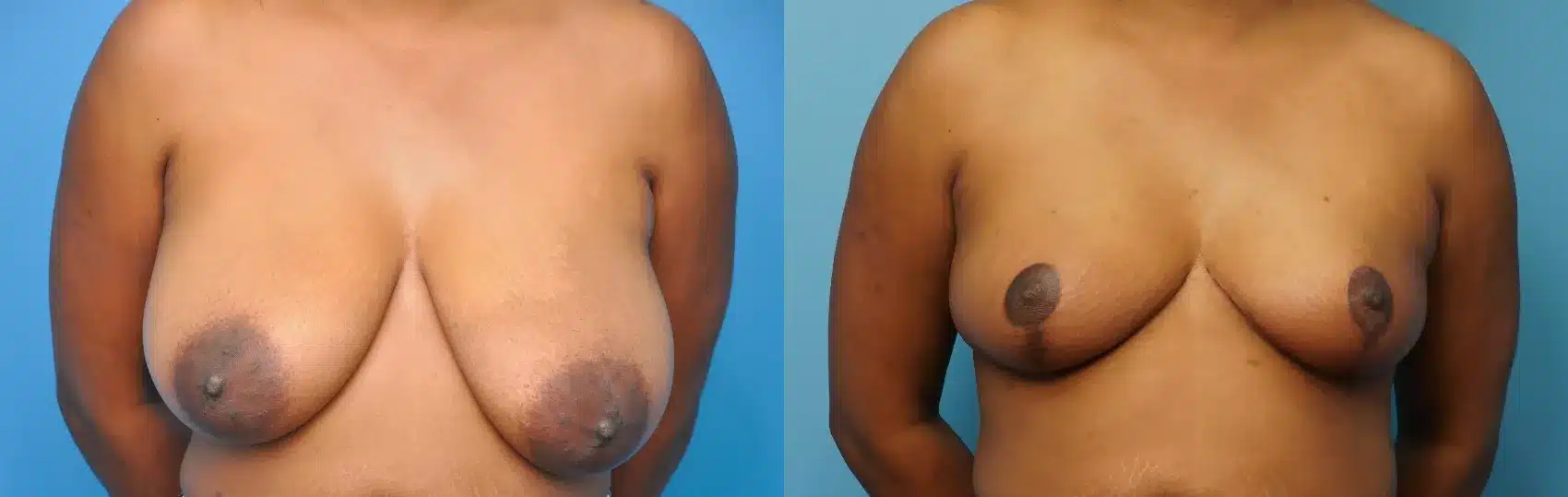 Before and After Image: Case #250 - front