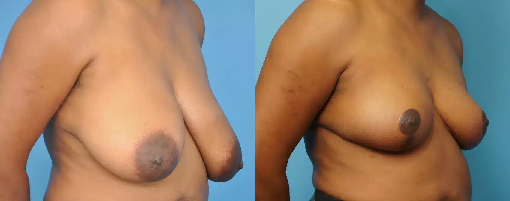 Before and After Image: Case #250 - right-front-oblique