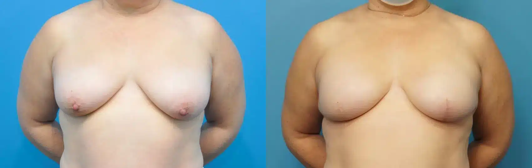Before and After Image: Case #251 - front