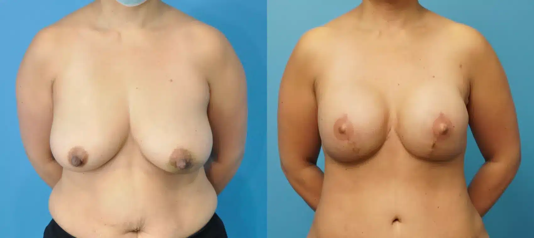 Before and After Image: Case #253 - front