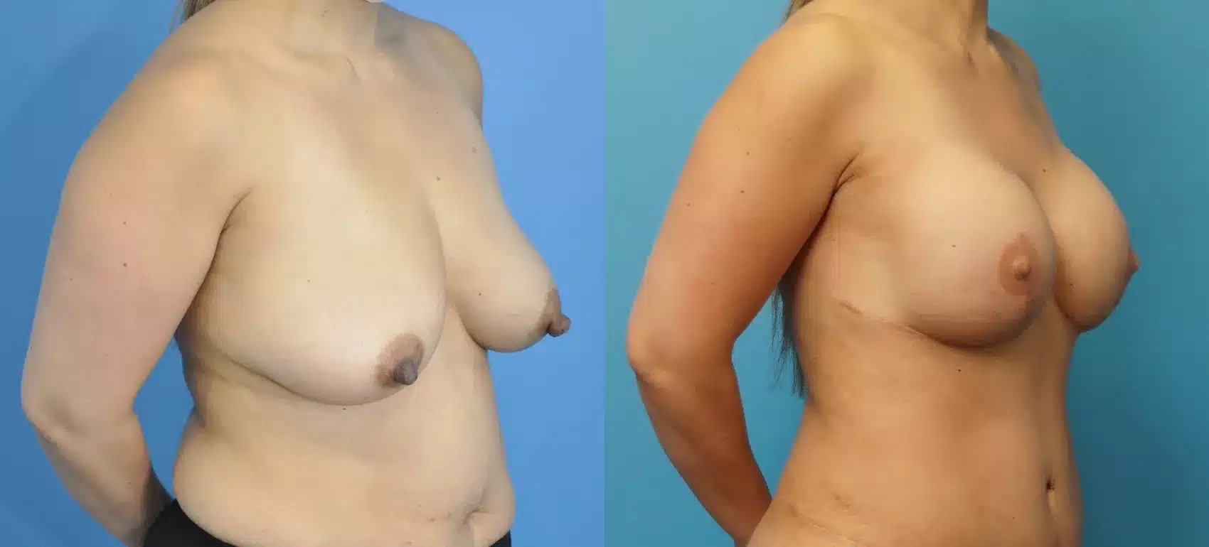 Before and After Image: Case #253 - right-front-oblique