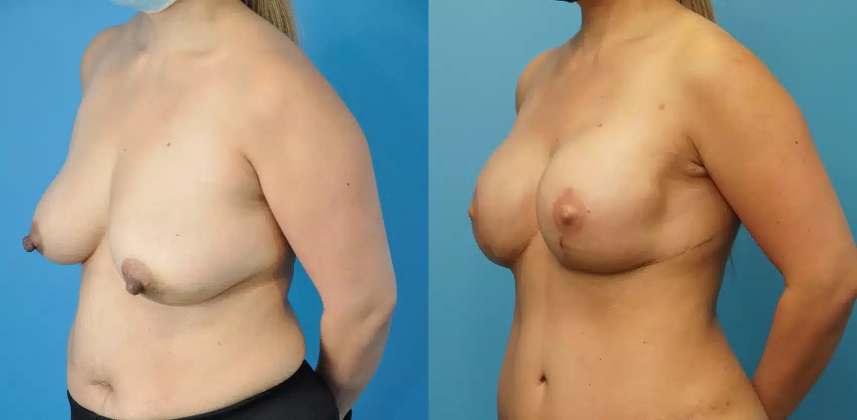Before and After Image: Case #253 - left-front-oblique