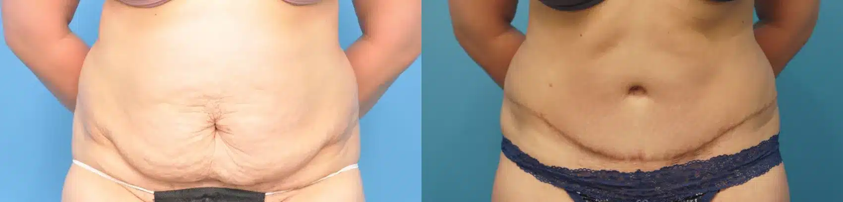 Before and After Image: Case #254 - front