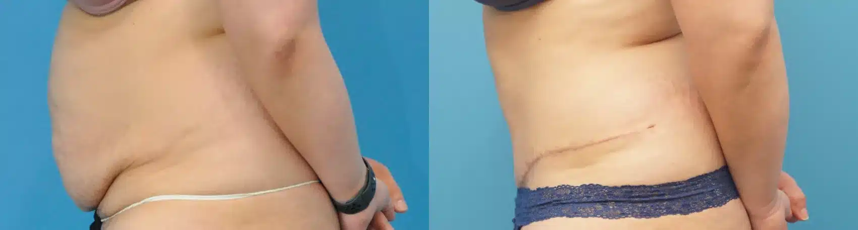 Before and After Image: Case #254 - left-side