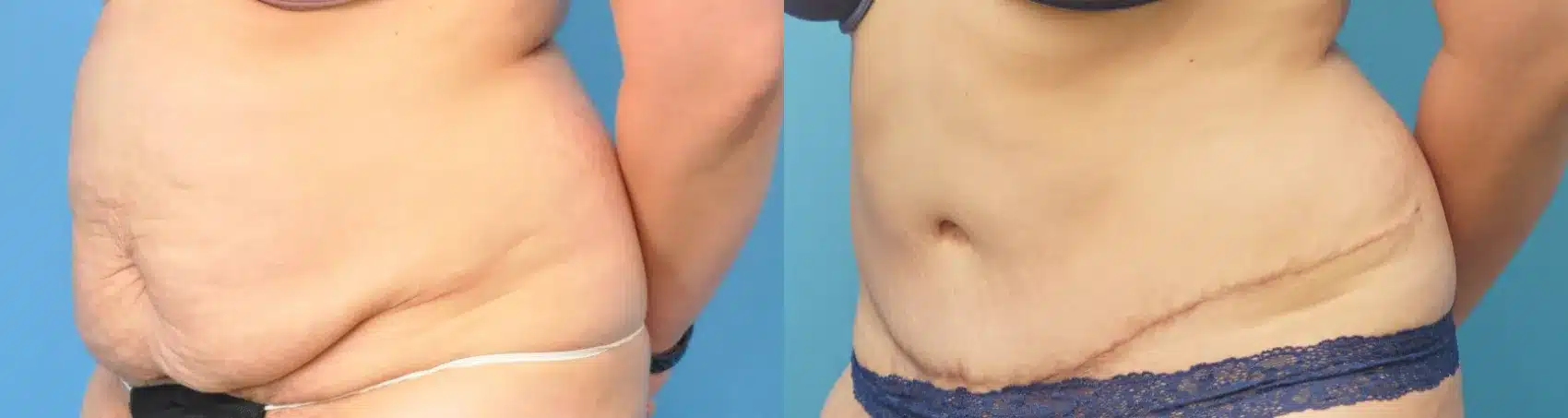 Before and After Image: Case #254 - left-front-oblique