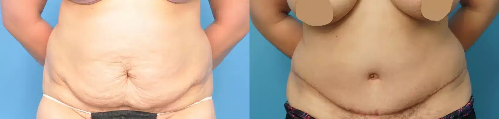 Before and After Image: Case #254 - front