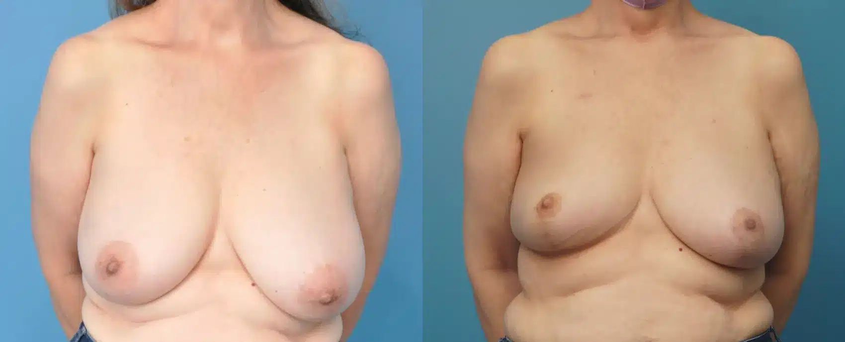 Before and After Image: Oncoplastic Reduction and Lift for Breast Cancer - front