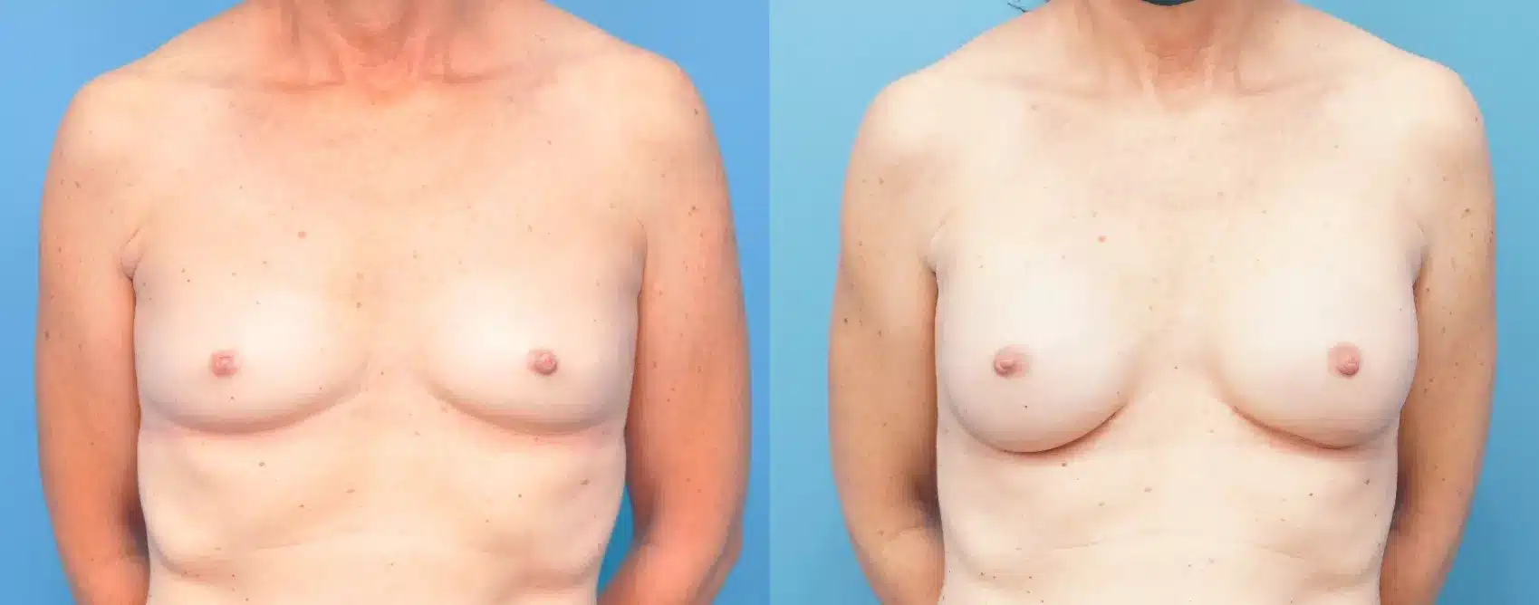 Before and After Image: Case #258 - front