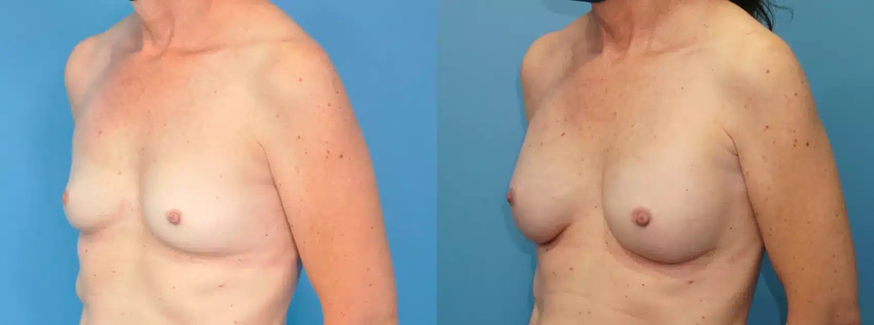 Before and After Image: Case #258 - left-front-oblique