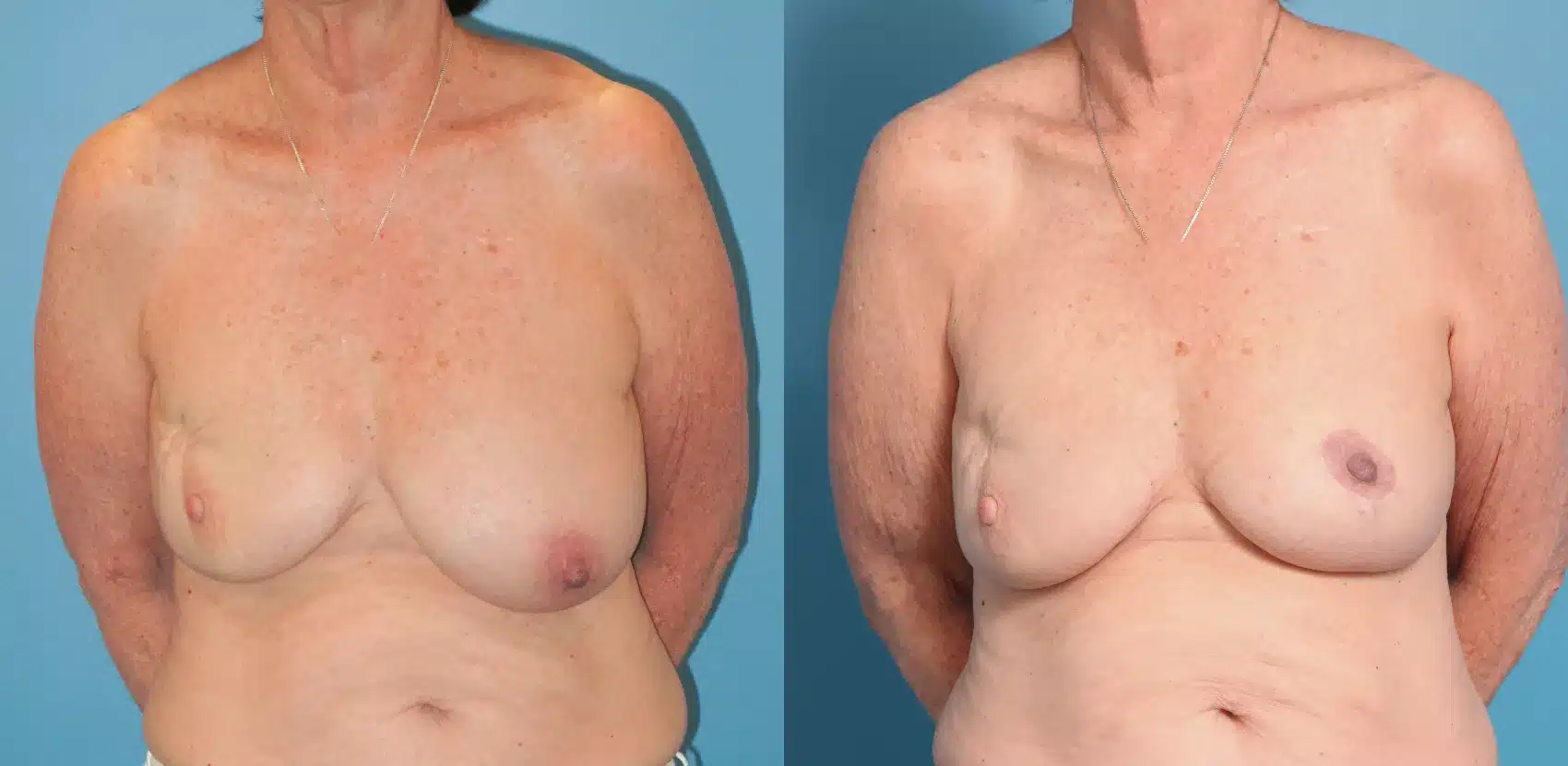 Before and After Image: Case #26 - front