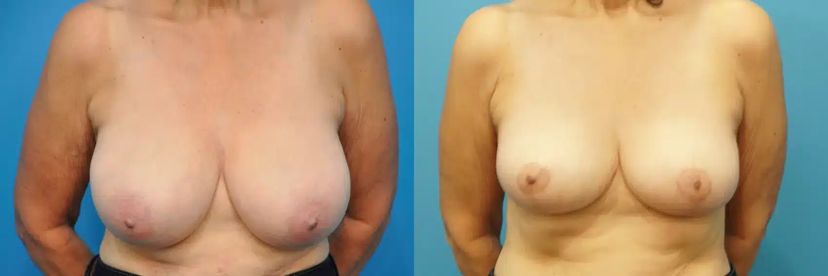 Before and After Image: Case #261 - front